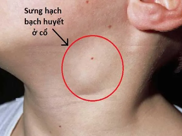 Sưng hạch bạch huyết ở cổ